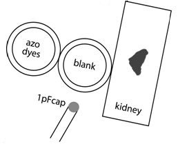 Take-out dyes from right kidney