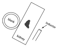 Making a bottle of the left kidney